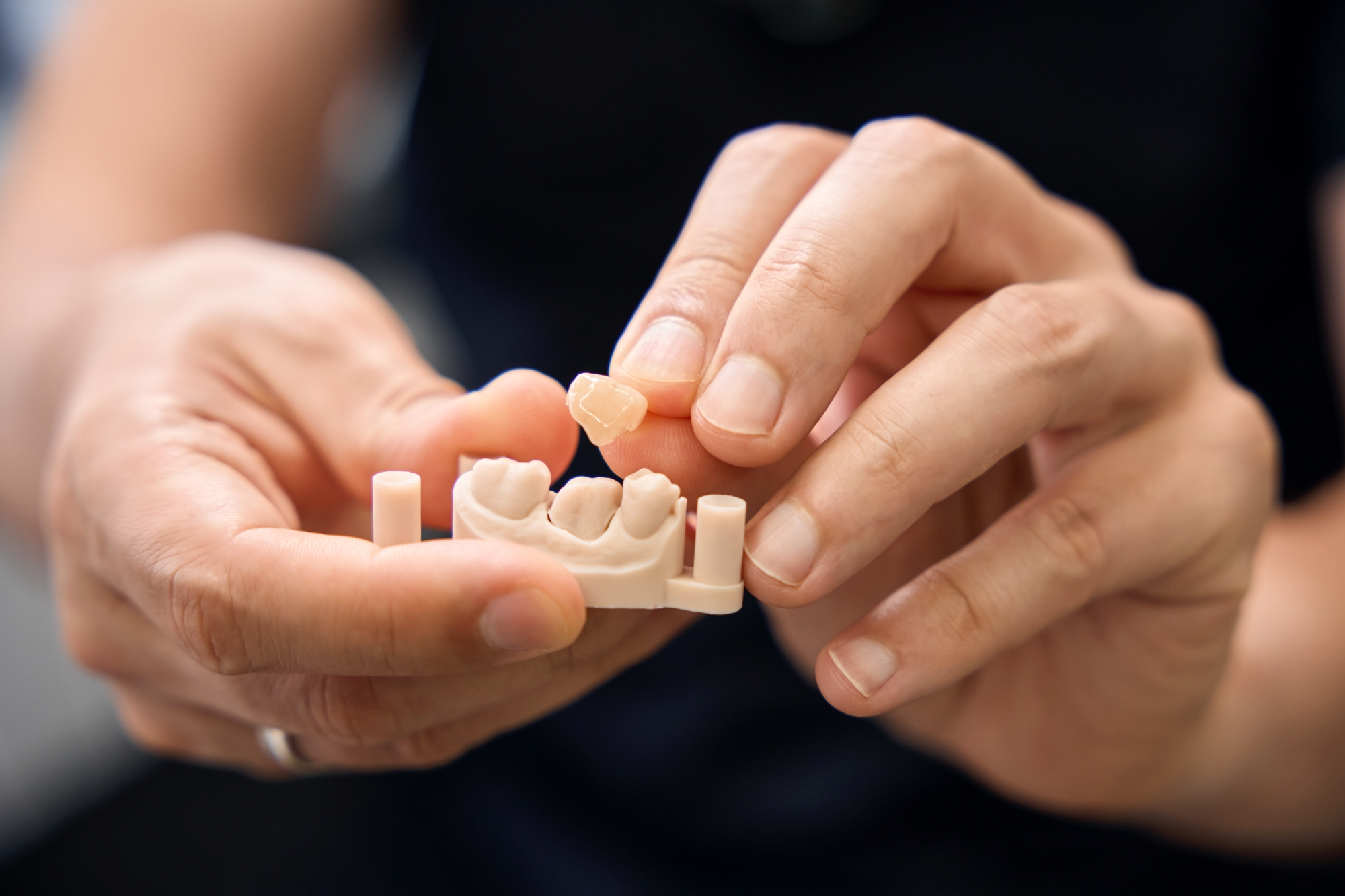 Hands holding a dental model showing a single tooth implant and crown placement demonstration.