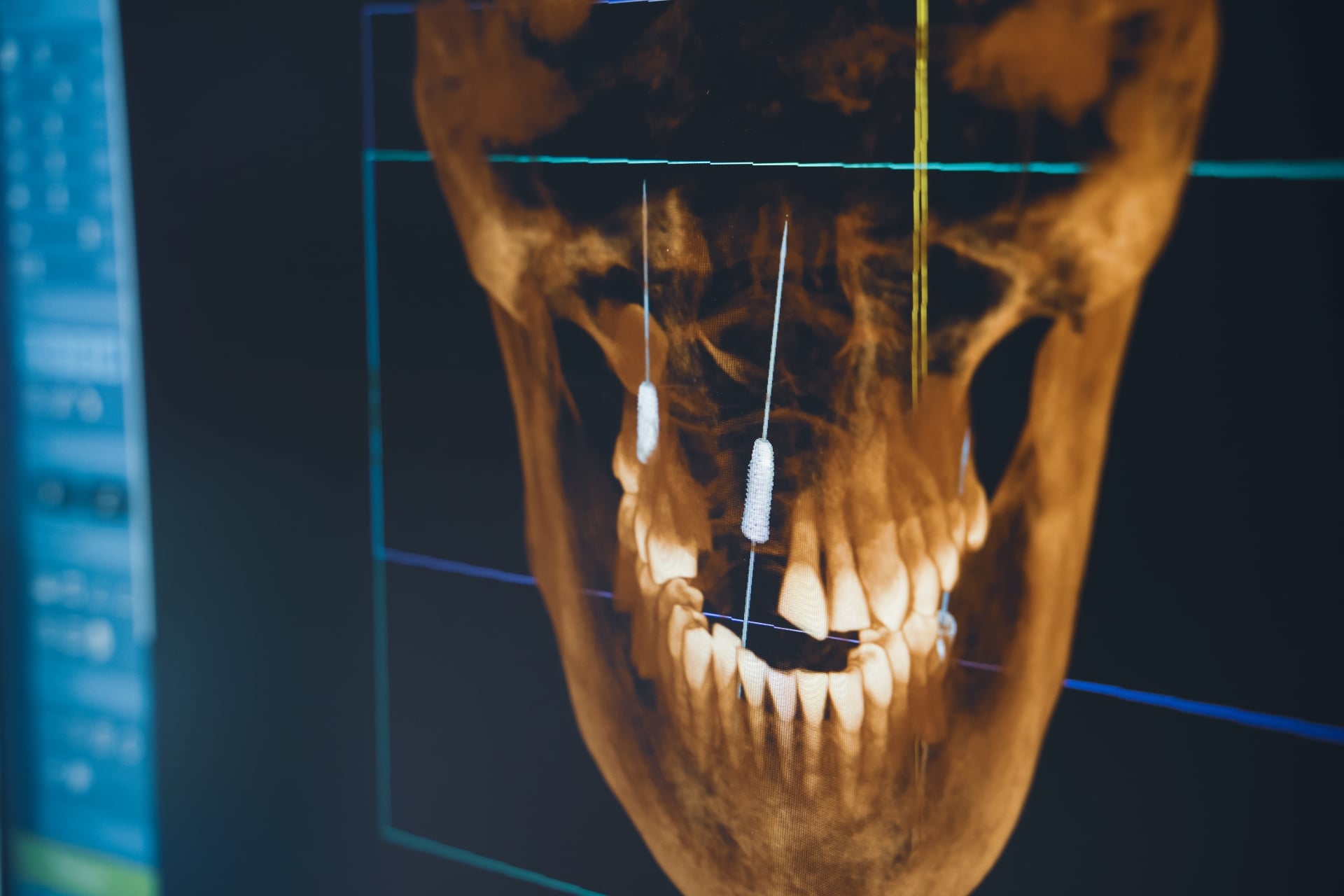 3D dental scan showing jawbone structure and planned dental implant placement before surgery. 