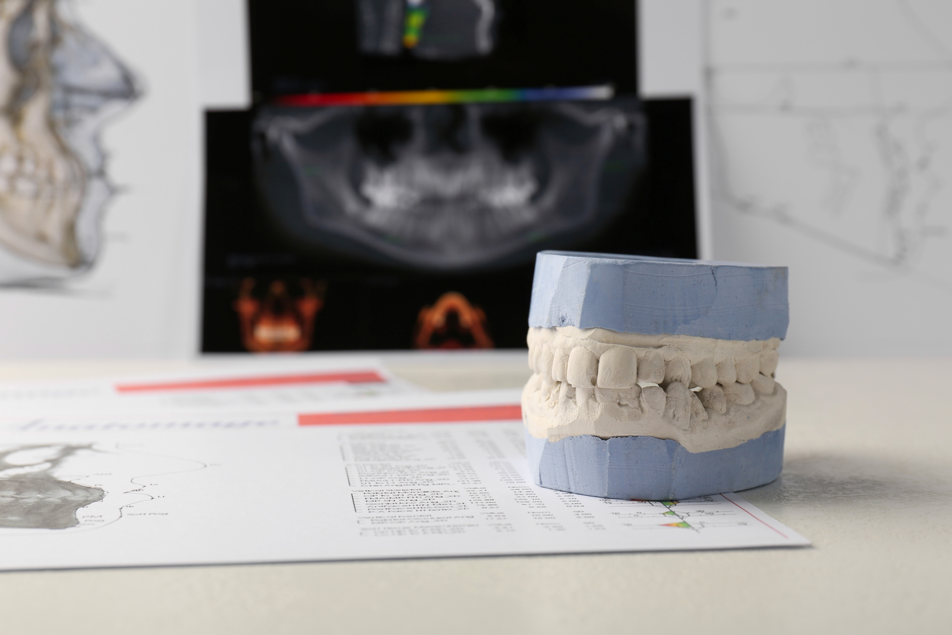 Dental mold sits on a desk with patient scans to show jaw bone loss at Premier Oral and Maxillofacial Surgery group.