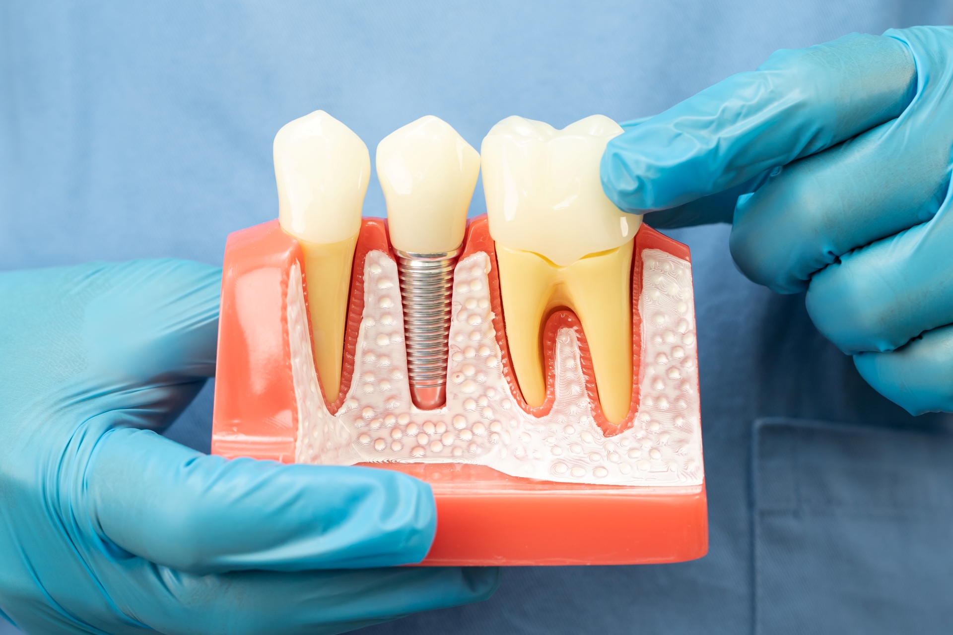 Premier Oral and Maxillofacial Surgery group expert holds a cross-section model highlighting a dental implant.