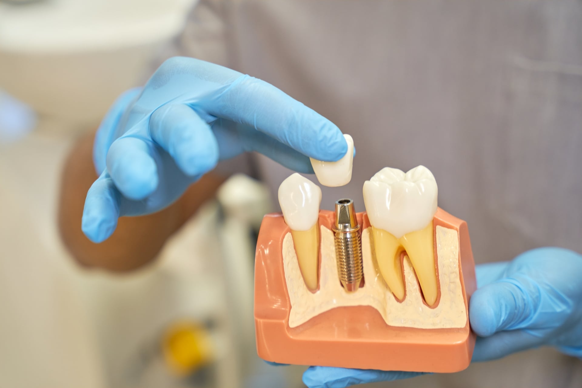 Premier Oral and Maxillofacial Surgery group expert places a dental crown onto an implant model to show recovery results.