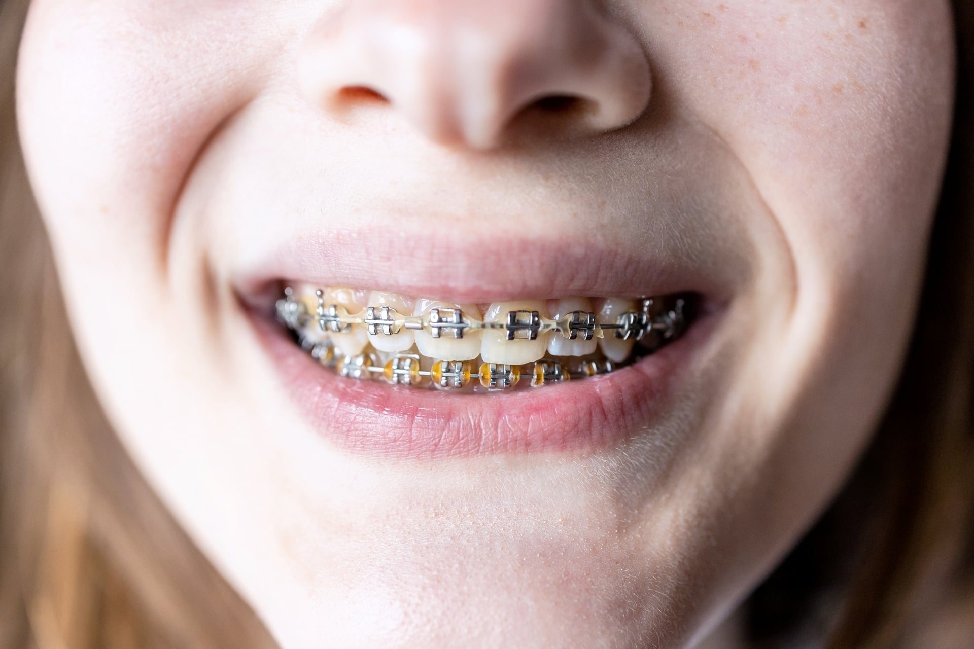 Teen patient smiling with braces used to guide impacted canine teeth into proper alignment during treatment.