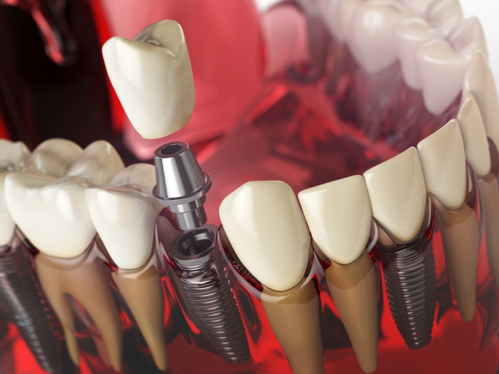 A clear 3D illustration of a dental implant crown abutment being shown at Premier Oral Surgery and Maxillofacial Group.