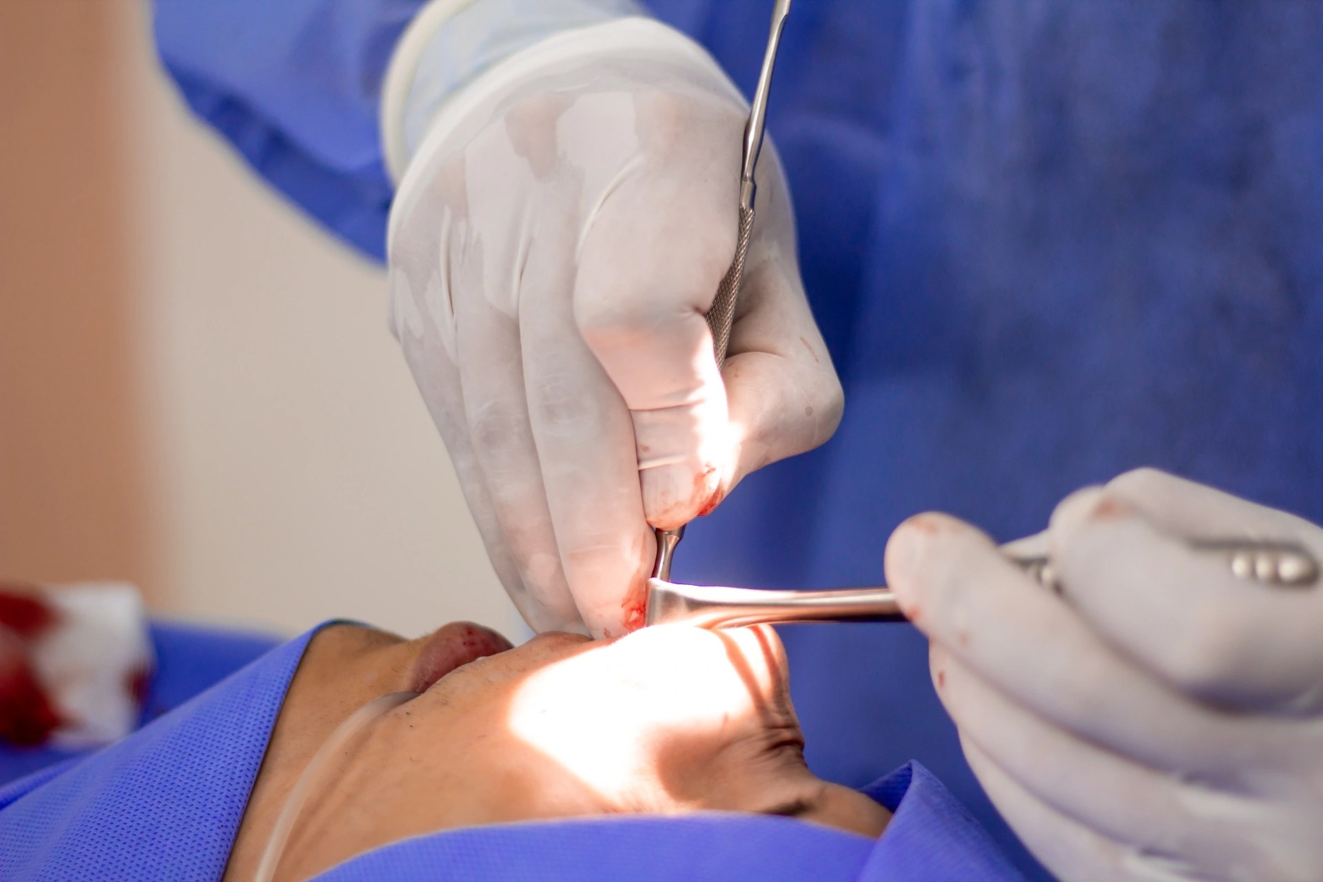 Premier Oral surgeon performing a precise surgical tooth extraction on a patient.
