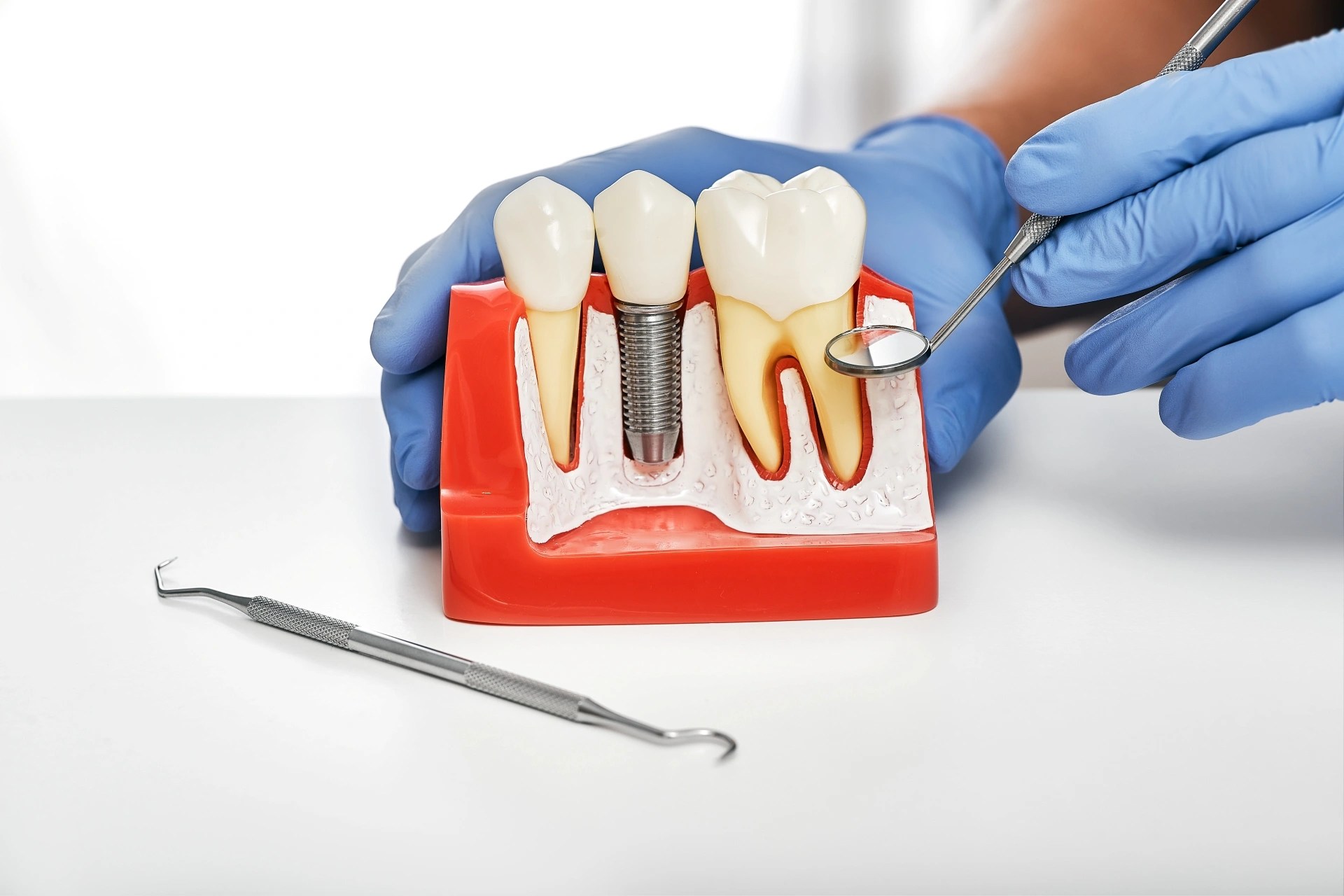 Dental implant model showing a healthy implant beside a natural tooth during a patient education demonstration.